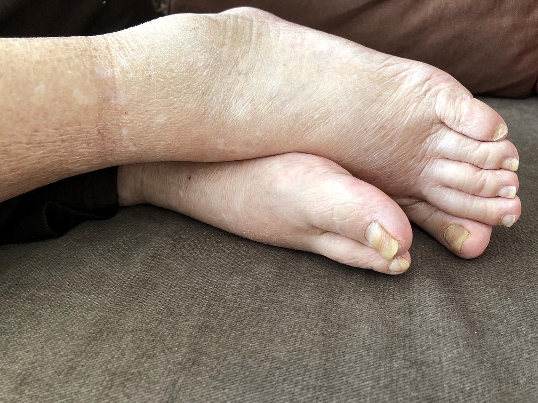 Icatibant Acetate treatment | Shaanxi BLOOM Tech Co., Ltd Icatibant Acetate treatment | Shaanxi BLOOM Tech Co., Ltd