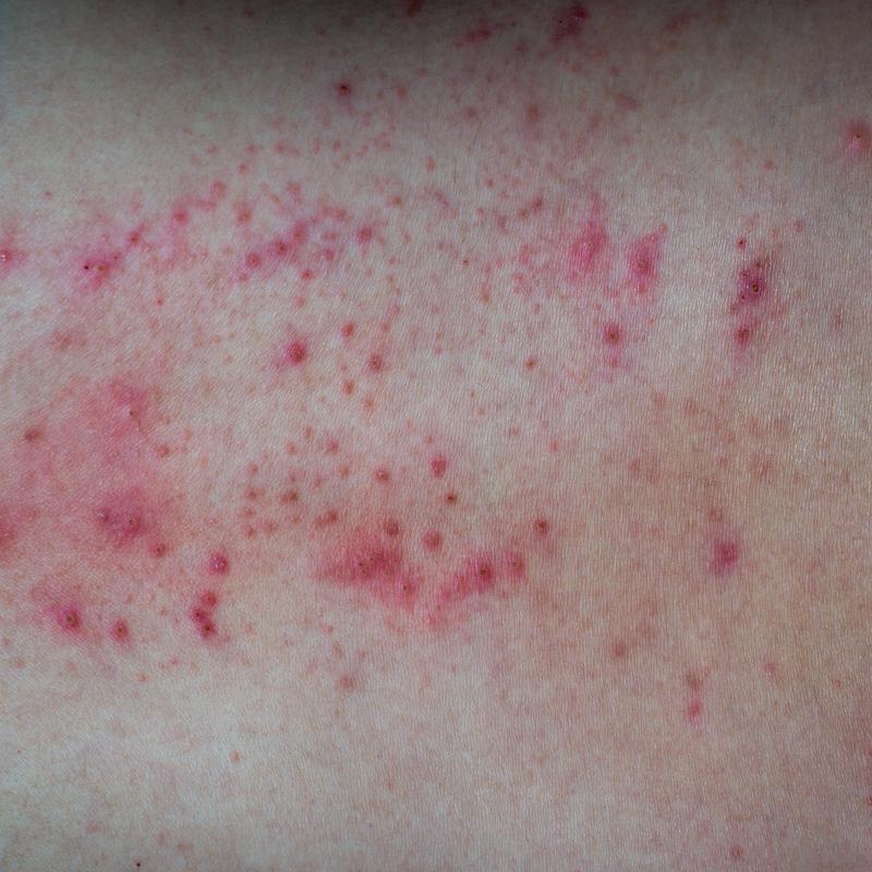 D-Norvaline Allergic Reaction | Shaanxi BLOOM Tech Co., Ltd D-Norvaline Allergic Reaction | Shaanxi BLOOM Tech Co., Ltd