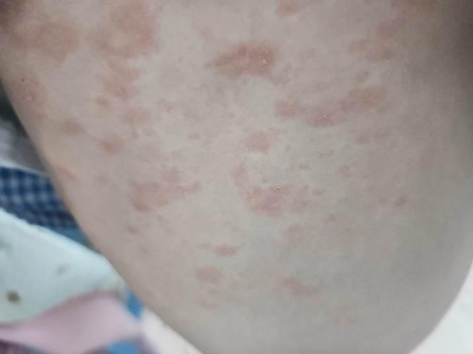 3-Chloroanisole Skin irritation | Shaanxi BLOOM Tech Co., Ltd 3-Chloroanisole Skin irritation | Shaanxi BLOOM Tech Co., Ltd