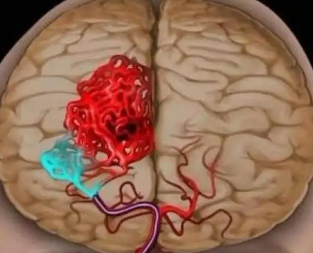 GS-441524 Neurological FIP | Shaanxi BLOOM Tech Co., Ltd