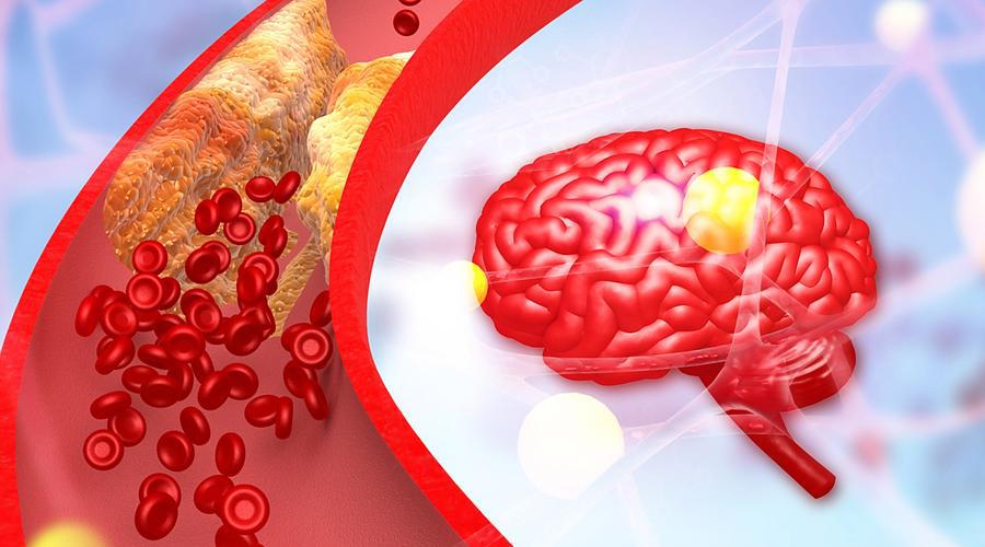 Cerebrolysin uses | Shaanxi BLOOM Tech Co., Ltd